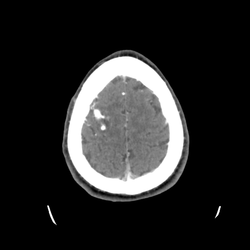 Cerebral arteriovenous malformation (Radiopaedia 55798-62371 B 44).png