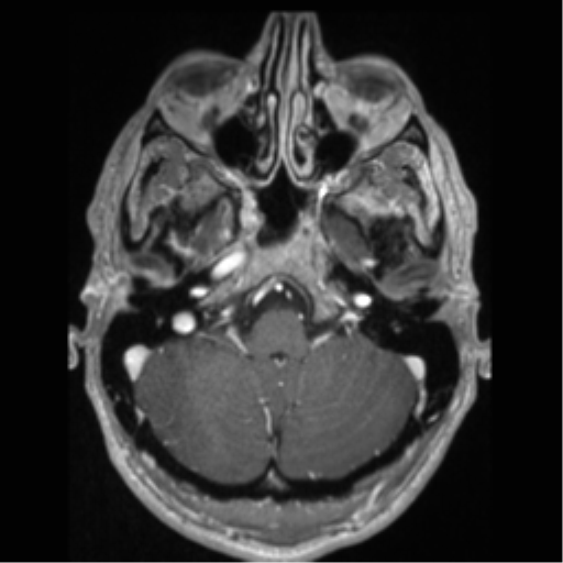 Cerebral arteriovenous malformation (Radiopaedia 55798-62372 Axial T1 C+ 14).png