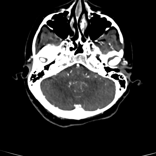 Cerebral arteriovenous malformation (Radiopaedia 73830-84645 Axial C+ delayed 74).jpg