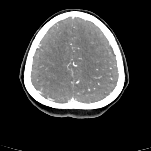 Cerebral arteriovenous malformation (Radiopaedia 73830-84645 B 22).jpg