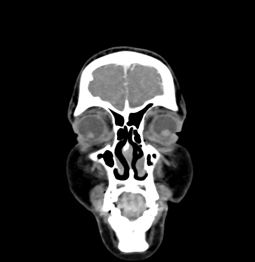 Cerebral arteriovenous malformation (Radiopaedia 73830-84645 C 11).jpg