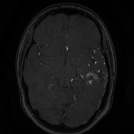 Cerebral arteriovenous malformation (Radiopaedia 74411-85654 Axial MRA 58).jpg