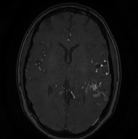 Cerebral arteriovenous malformation (Radiopaedia 74411-85654 Axial MRA 76).jpg