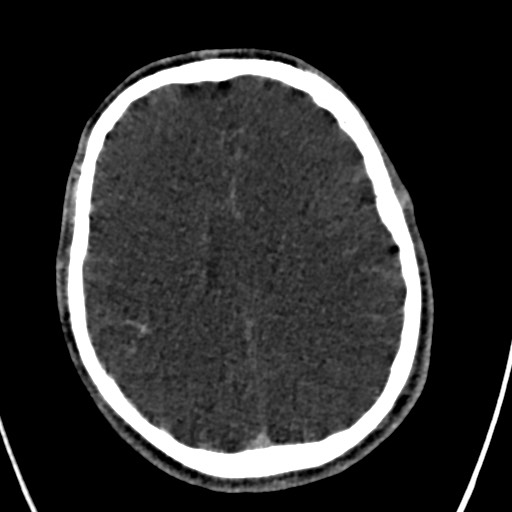 Cerebral arteriovenous malformation (Radiopaedia 78188-90746 Axial C+ delayed 113).jpg