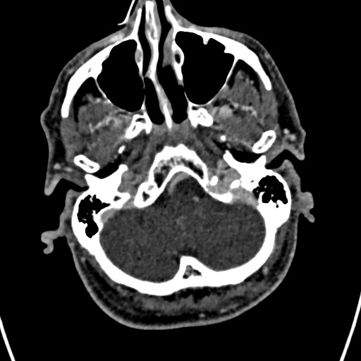 Cerebral arteriovenous malformation (Radiopaedia 78188-90746 Axial C+ delayed 26).jpg