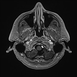 Cerebral arteriovenous malformation (Radiopaedia 84015-99245 Axial T1 C+ 26).jpg