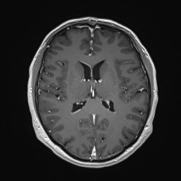 Cerebral arteriovenous malformation (Radiopaedia 84015-99245 Axial T1 C+ 90).jpg