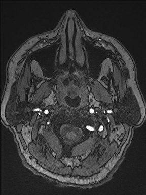 File:Cerebral arteriovenous malformation (Radiopaedia 84015-99245 Axial TOF 11).jpg