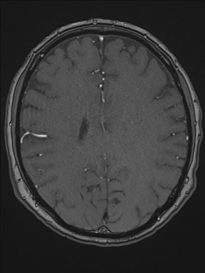 File:Cerebral arteriovenous malformation (Radiopaedia 84015-99245 Axial TOF 153).jpg