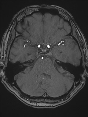 File:Cerebral arteriovenous malformation (Radiopaedia 84015-99245 Axial TOF 87).jpg
