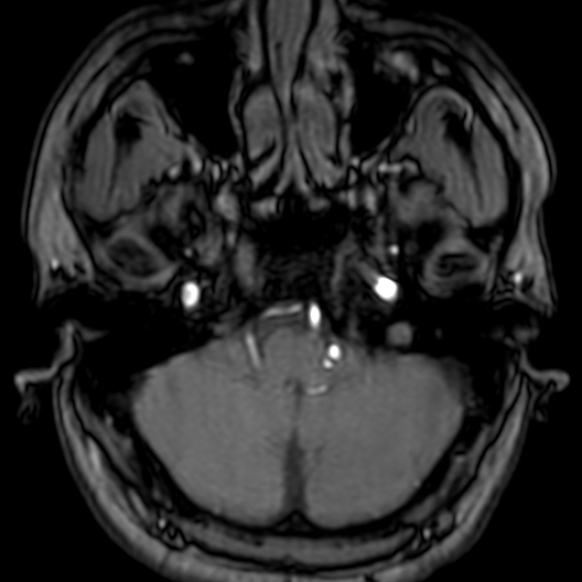 Cerebral arteriovenous malformation at posterior body of corpus callosum (Radiopaedia 74111-84925 Axial MRA 26).jpg