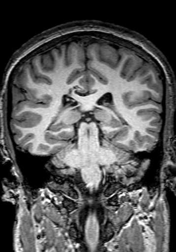 Cerebral arteriovenous malformation at posterior body of corpus callosum (Radiopaedia 74111-84925 Coronal T1 210).jpg