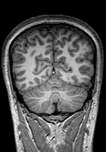 Cerebral arteriovenous malformation at posterior body of corpus callosum (Radiopaedia 74111-84925 Coronal T1 273).jpg