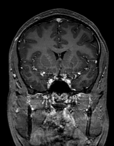 Cerebral arteriovenous malformation at posterior body of corpus callosum (Radiopaedia 74111-84925 K 134).jpg