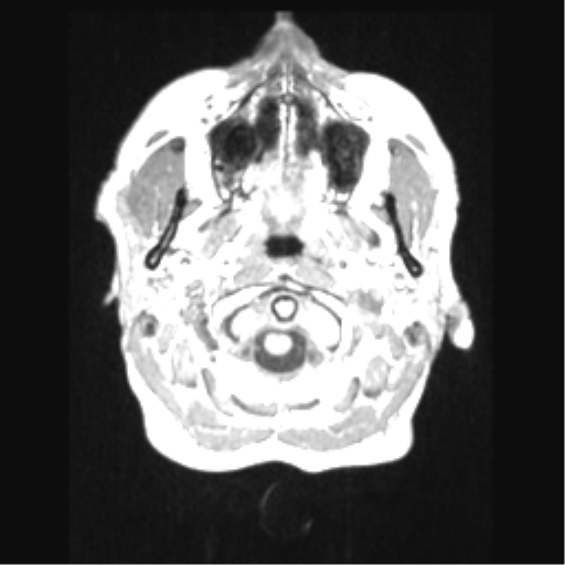 Cerebral arteriovenous malformation with hemorrhage (Radiopaedia 34422-35737 Axial T1 3).png