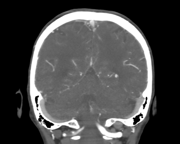 Cerebral arteriovenous malformation with lobar hemorrhage (Radiopaedia 44725-48511 A 42).png