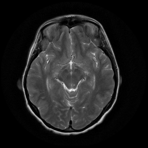 File:Cerebral autosomal dominant arteriopathy with subcortical infarcts and leukoencephalopathy (CADASIL) (Radiopaedia 41018-43763 Ax T2 PROP 9).png