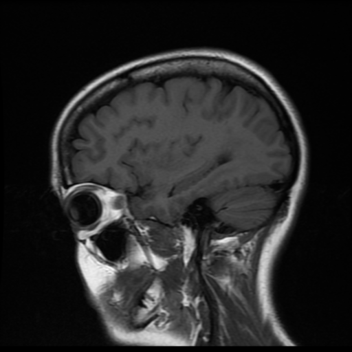 File:Cerebral autosomal dominant arteriopathy with subcortical infarcts and leukoencephalopathy (CADASIL) (Radiopaedia 41018-43768 Sagittal T1 15).png