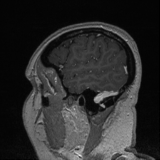 File:Cerebral cavernoma and development venous anomaly (Radiopaedia 37603-39482 Sagittal T1 C+ 80).png