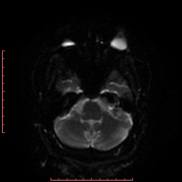 File:Cerebral cavernous malformation (Radiopaedia 26177-26306 Axial DWI 26).jpg