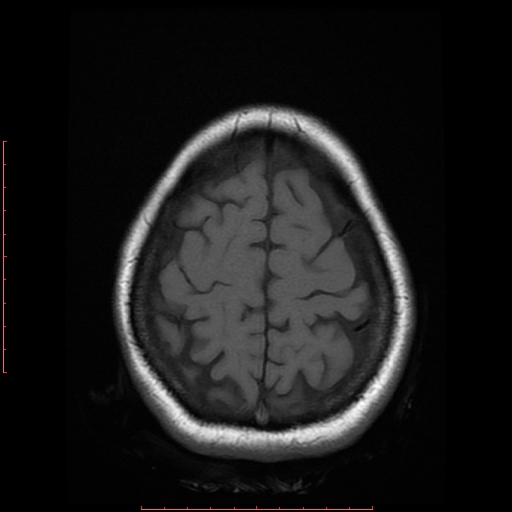 File:Cerebral cavernous malformation (Radiopaedia 26177-26306 Axial T1 18).jpg