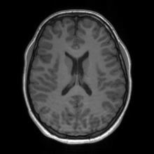 Cerebral cavernous venous malformation (Radiopaedia 70008-80021 Axial T1 46).jpg