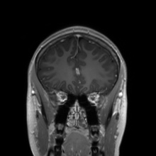 Cerebral cavernous venous malformation (Radiopaedia 70008-80021 Coronal T1 C+ 46).jpg