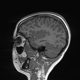 File:Cerebral cavernous venous malformation (Radiopaedia 70008-80021 Sagittal T1 20).jpg