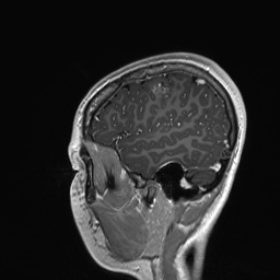 Cerebral cavernous venous malformation (Radiopaedia 70008-80021 Sagittal T1 C+ 12).jpg