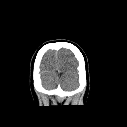 Cerebral cavernous venous malformation (Radiopaedia 70008-80022 non-contrast 65).jpg