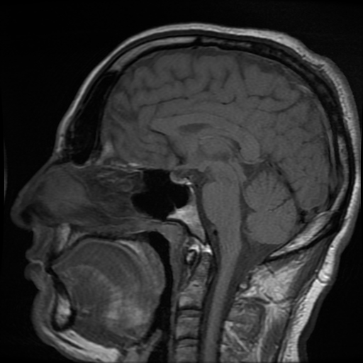 File:Cerebral cavernous venous malformation (Zabramski type II) (Radiopaedia 85511-101198 Sagittal T1 19).jpg