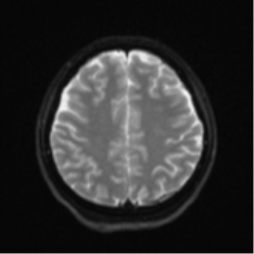 Cerebral cavernous venous malformations (Radiopaedia 48117-52946 Axial DWI 20).png