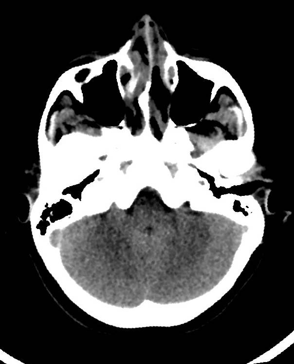 Cerebral edema due to severe hyponatremia (Radiopaedia 89826-106938 Axial non-contrast 24).jpg