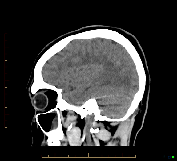 Cerebral fat embolism (Radiopaedia 85521-101220 B 39).jpg