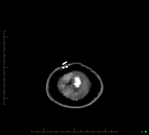 Cerebral fat embolism (Radiopaedia 85521-101224 Axial non-contrast 54).jpg