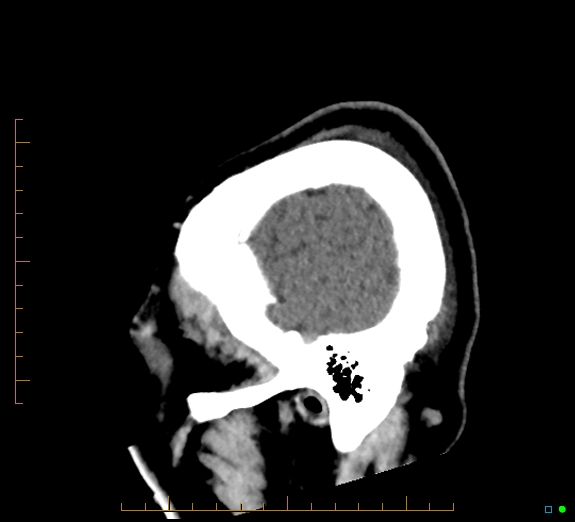 Cerebral fat embolism (Radiopaedia 85521-101224 C 6).jpg