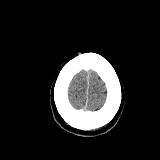 File:Cerebral hemorrhagic contusions- temporal evolution (Radiopaedia 40224-42754 Axial non-contrast 28).png