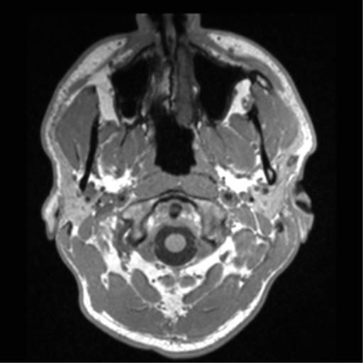 Cerebral hemorrhagic contusions- temporal evolution (Radiopaedia 40224-42757 Axial T1 3).png