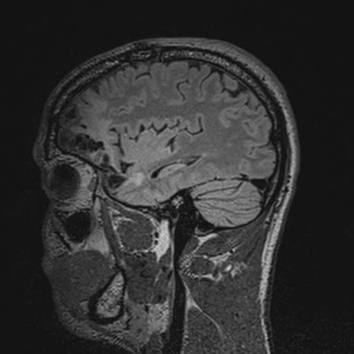 File:Cerebral hemorrhagic contusions- temporal evolution (Radiopaedia 40224-42757 Sagittal T1 59).png