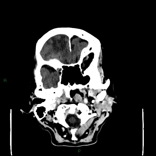 File:Cerebral metastases - breast primary (Radiopaedia 77653-89857 Axial C+ delayed 20).jpg