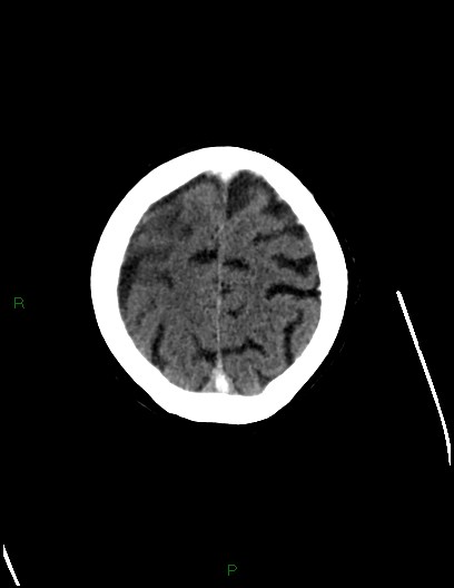Cerebral metastases - ependymal and parenchymal (Radiopaedia 79877-93131 Axial C+ delayed 71).jpg