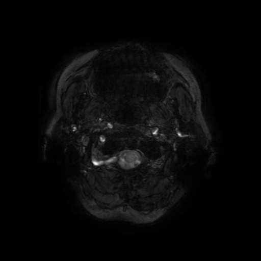 File:Cerebral metastases - melanoma (Radiopaedia 80972-94522 Axial SWI 1).jpg