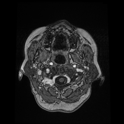 File:Cerebral metastases - melanoma (Radiopaedia 80972-94522 Axial T1 C+ 18).jpg