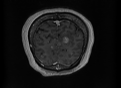 Cerebral metastases from lung cancer with amyloid angiopathy and cerebellopontine angle meningioma (Radiopaedia 74306-85191 Coronal T1 C+ 55).jpg