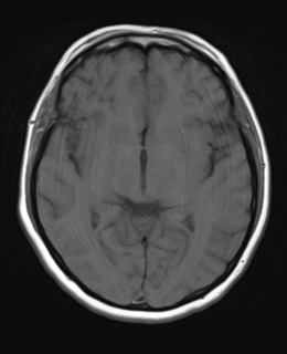 File:Cerebral metastases mimicking abscesses (Radiopaedia 45841-50131 Axial T1 14).png