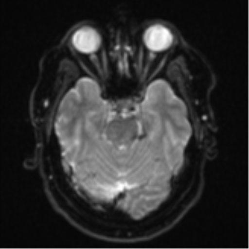 Cerebral metastases mimicking multifocal glioblastoma (Radiopaedia 50843-56353 Axial DWI 9).png