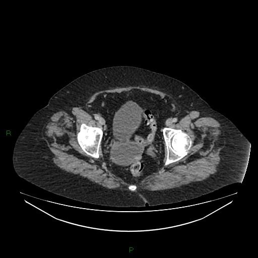 File:Cerebral metastasis from renal cell carcinoma (Radiopaedia 82306-96378 A 176).jpg