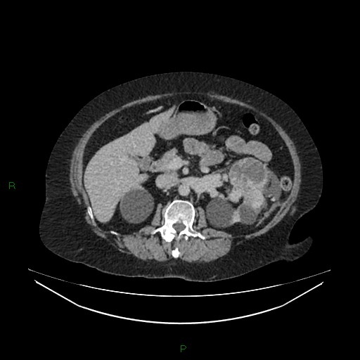 Cerebral metastasis from renal cell carcinoma (Radiopaedia 82306-96378 A 67).jpg