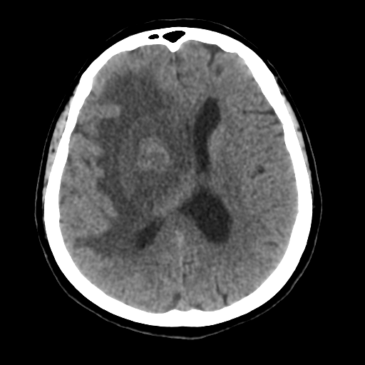 Cerebral metastasis to basal ganglia (Radiopaedia 81568-95412 Axial non-contrast 37).png