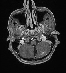 Cerebral toxoplasmosis (Radiopaedia 43956-47461 Axial T1 C+ 7).jpg